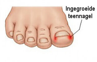 Ingegroeide teennagel
