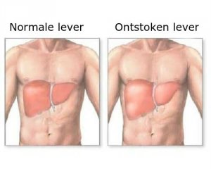 Een leverontsteking: symptomen en een goed dieet