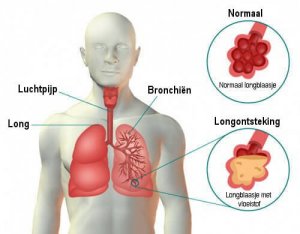 Longontsteking: symptomen en remedies
