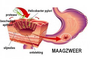 Zo bestrijd je de Helicobacter Pylori-bacterie