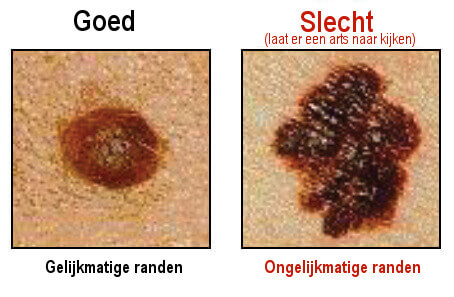 Veranderingen in de huid of moedervlekken een van de symptomen van kanker