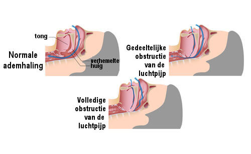 Oorzaak van Snurken