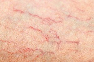 Wat te doen tegen spataderen