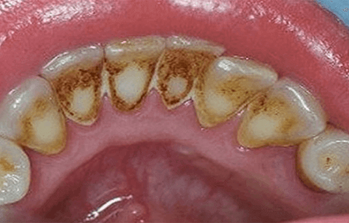 Tandplak verwijderen en je orale gezondheid verbeteren