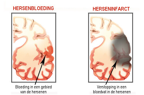 Tekenen van een Beroerte