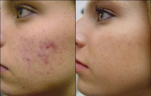 openbaar academisch Intimidatie 4 zelfgemaakte gezichtsmaskers tegen acne - Gezonder Leven