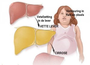 Heb je leververvetting? Herken de symptomen