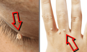 Natuurlijke middelen om wratten te verwijderen