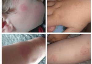 Gevolgen van de ziekte van Lyme