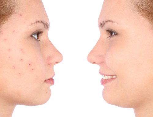 Acne elimineren met appelazijn