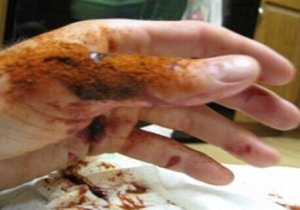 Een gel die bloedingen binnen 10 seconden stopt