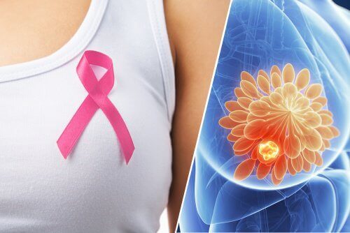 10 waarschuwingstekens van borstkanker