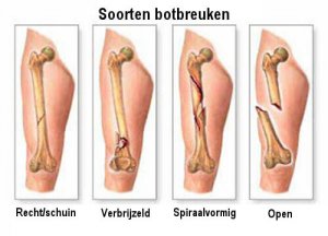 5 symptomen van primaire botkanker
