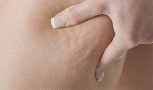 Cellulite bestrijden met 3 medicinale infusies