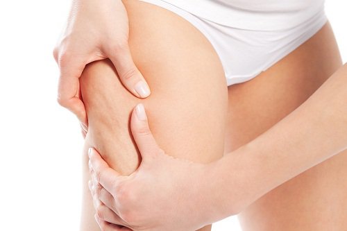 Cellulite behandelen