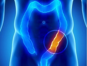 90% van de ziektes is gelinkt aan een ongezonde dikke darm