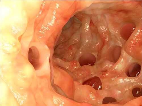 Diverticulitis