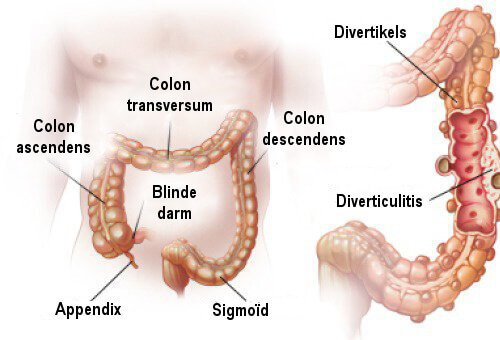 Diverticulitis en diverticulose: diagnose en behandeling