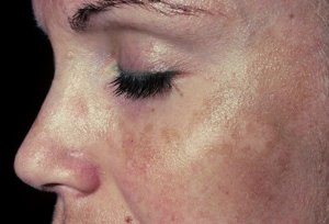 6 remedies om donkere vlekken te verwijderen