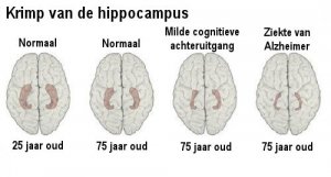 Herken de vroege tekenen van Alzheimer