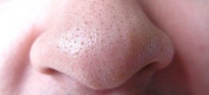 Acne en mee-eters: groene thee kan helpen