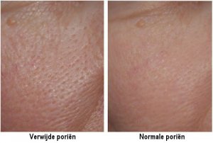 Grove poriën? Probeer deze 3 maskers!