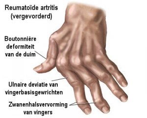 7 natuurlijke middelen tegen artritis in de handen