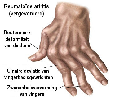 Curcumine voor gewrichten - reuma en artrose