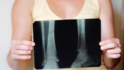 Röntgenfoto van benen