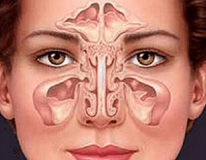 Sinusitis op natuurlijke wijze behandelen