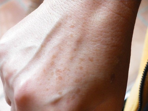 sproeten-hand