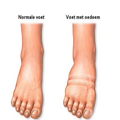 Een voet met oedeem