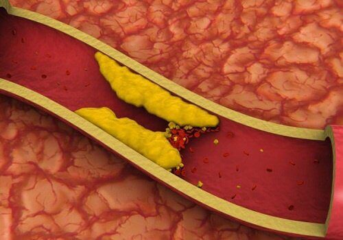 8 infusies om je cholesterolgehalte te verlagen