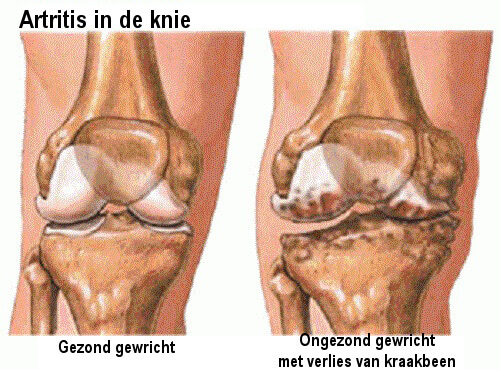 Artritis in de Knie
