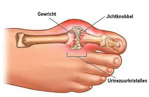 Jicht aan de Grote Teen