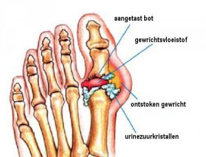 Natuurlijk middel voor de behandeling van jicht
