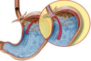 6 remedies tegen zure oprispingen