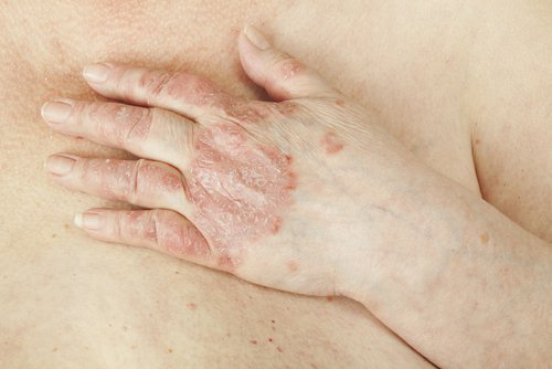 Psoriasis op de handen