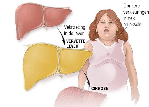 Symptomen van leververvetting
