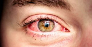 Rode en waterige ogen moeten behandeld om gezonde ogen te krijgen