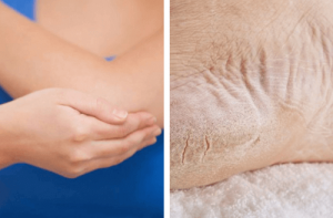 Behandel droge ellebogen en voeten in een week