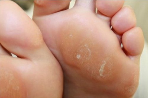 Natuurlijke eeltcrème voor je voeten