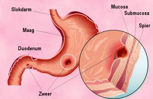 Natuurlijke behandelingen voor een maagzweer