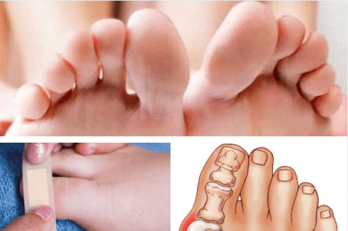 Alles over teen- en voetaandoeningen