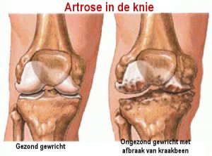 Symptomen van artrose en hoe te voorkomen