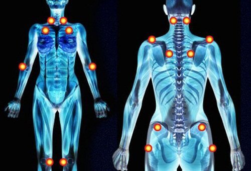 De triggerpoints van fibromyalgie
