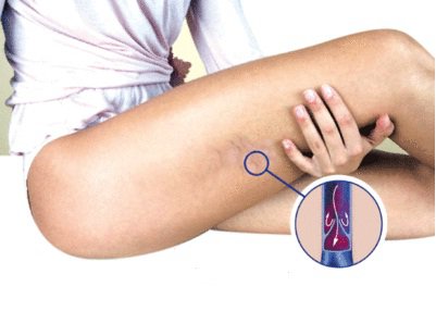 Symptomen van arteriosclerose in de ledematen