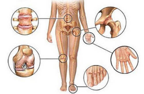 Gewrichtspijn kan voorkomen in de rug, heup, knie, teen en hand