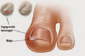 Zes oude middeltjes tegen ingegroeide teennagels