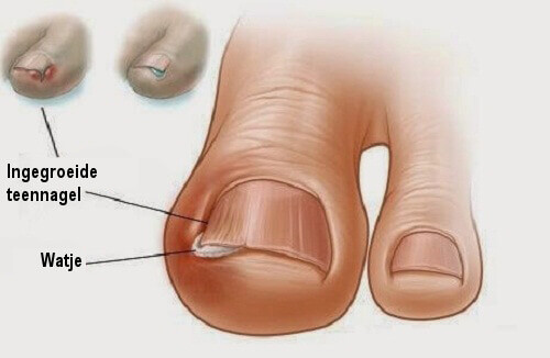 Ingegroeide teennagel